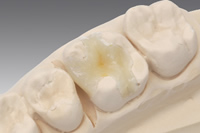 セラミックインレー