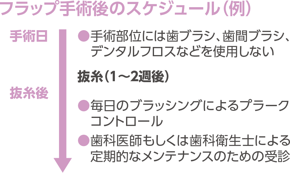 フラップ手術後のスケジュール（例）